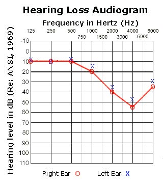 hearing loss audiogram